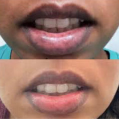 Brightening lips set